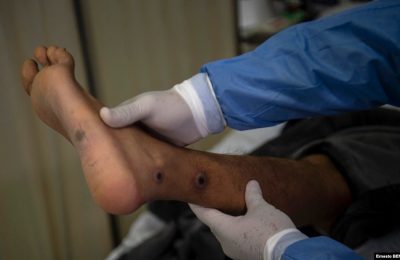Seorang dokter memeriksa pasien yang luka akibat infeksi cacar monyet di Peru, sebagai ilustrasi. Dokter mengatakan penularan cacar monyet tidak semudah seperti halnya COVID-19.(Foto: AFP/Ernesto BENAVIDES)