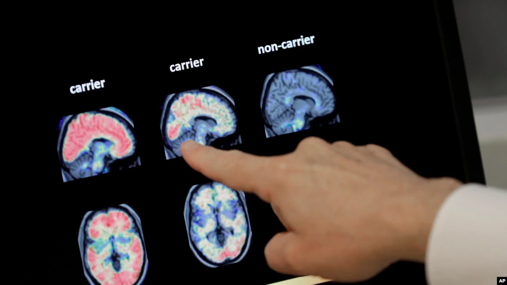 Seorang dokter mengamati hasil pemindaian otak pada seorang pasien di Phoenix pada 14 Agustus 2018. (Foto: AP/Matt York)